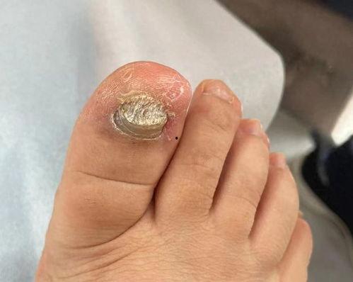 修脚灰指甲视频,轻松告别脚部困扰
